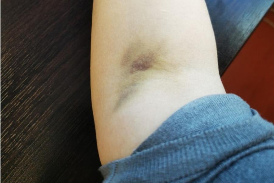 Пациентка в шоке: рука превратилась в синее месиво после сдачи крови в Гулбья