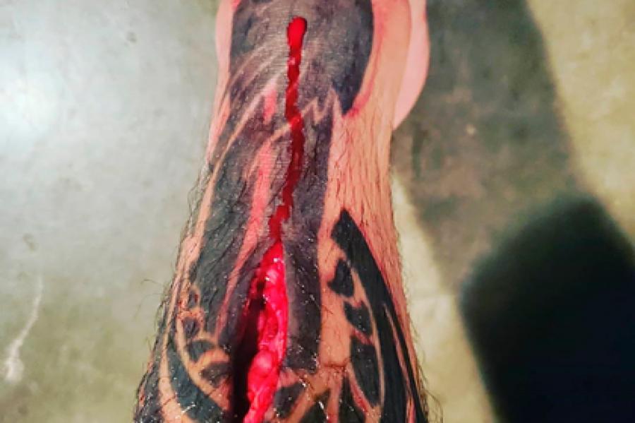 Фото кровавой раны бойца UFC после поединка испугало фанатов