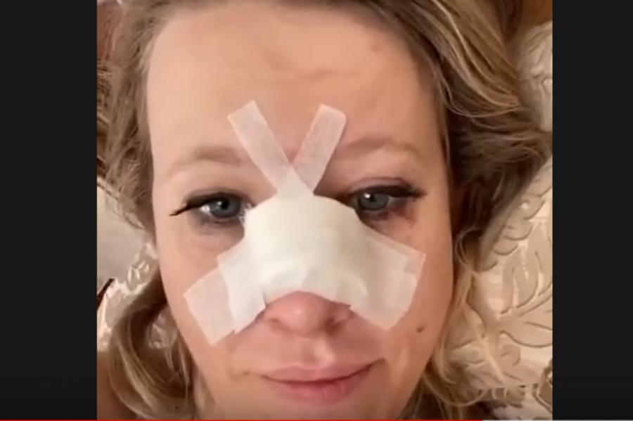 Ксения Собчак сломала нос