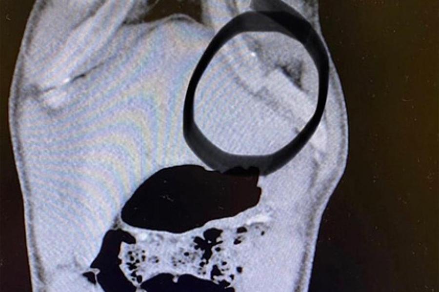 Снимок сломанного ребра бывшего чемпиона UFC испугал пользователей сети
