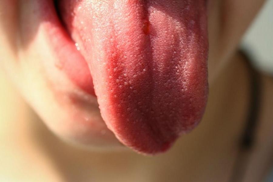 Покраснение языка оказалось симптомом опасного заболевания