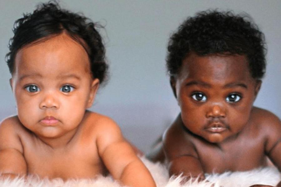 Уникальные близнецы: как выглядят сестры, которые родились с разным цветом кожи