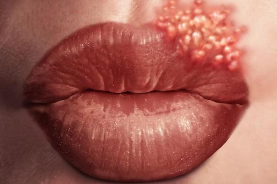 Герпес и не только: какие опасные болезни можно "подцепить" через поцелуй
