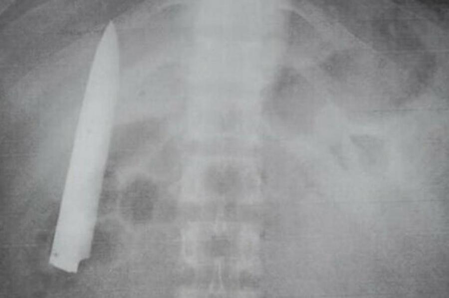 Год жил с ножом в грудной клетке: 26-летний парень винит врачей в халатности