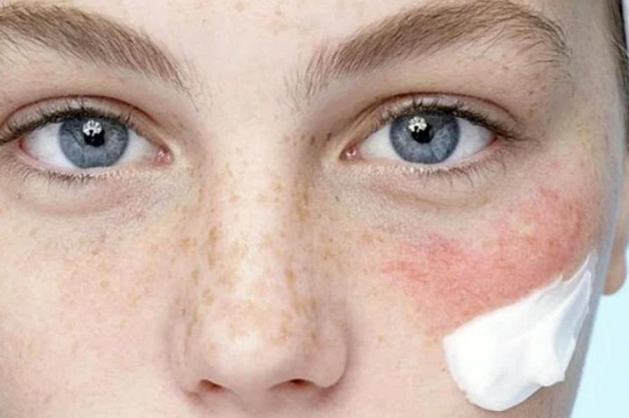 Аллергия после косметики - куда жаловаться?