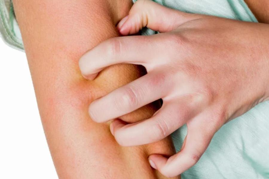 Аллергия на коже в дачный сезон: чего остерегаться и как лечиться?