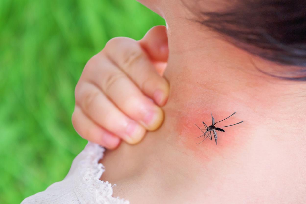 У ребёнка слишком сильная реакция на укусы насекомых. Как ему помочь?