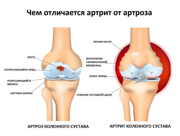 В чем разница между артрозом, артритом и остеопорозом