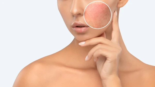 Изображение к статье: Когда краснеет лицо — и почему это не всегда опасно