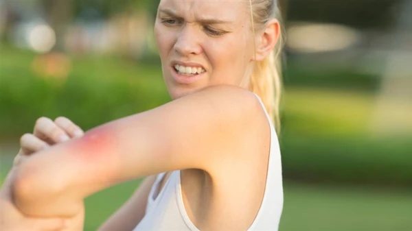 Изображение к статье: Как облегчить зуд после укусов насекомых: полезные лайфхаки