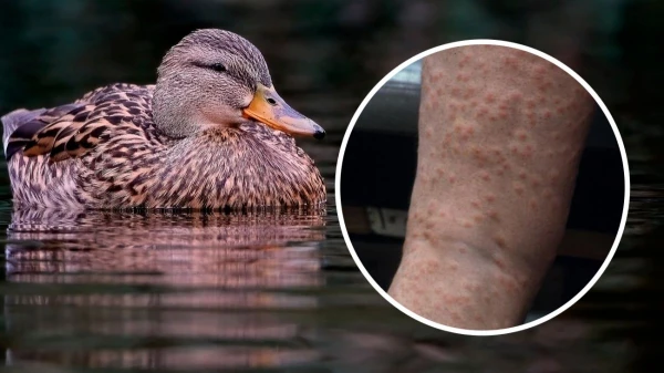 Изображение к статье: Церкариоз: почему нельзя купаться в пруду, где плавают утки