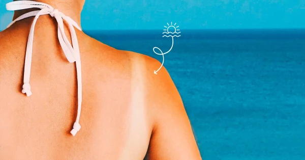 Изображение к статье: Внимание! Лекарства, которые увеличивают риск солнечных ожогов