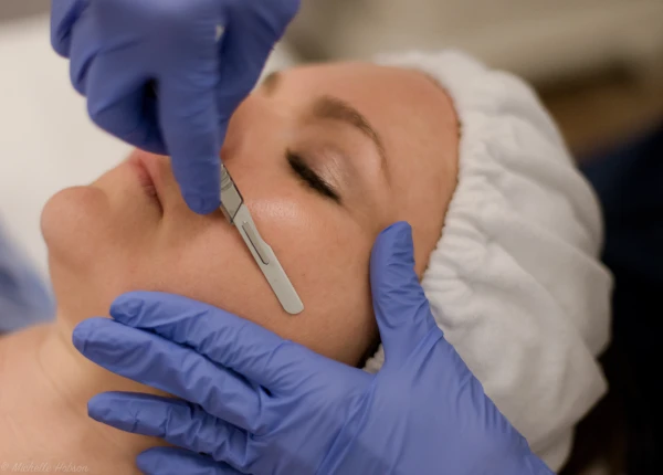 Изображение к статье: Дермапланинг: что это за процедура и зачем она нужна