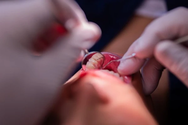 Изображение к статье: Разработан метод раннего предсказания появления кариеса