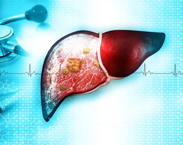 Изображение к статье: Американские токсикологи выяснили, что сильнее всего разрушает печень: это не только алкоголь