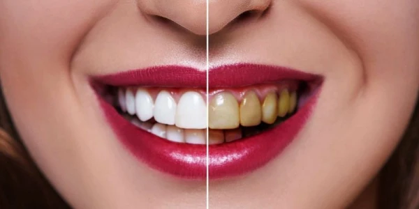 Изображение к статье: Голливудская улыбка: как победить желтый налет на зубах