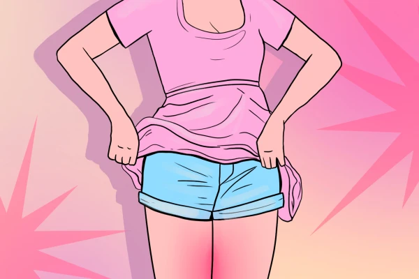 Изображение к статье: Дискомфорт, о котором не говорят: Что делать в случае натертости между бедрами в жару?