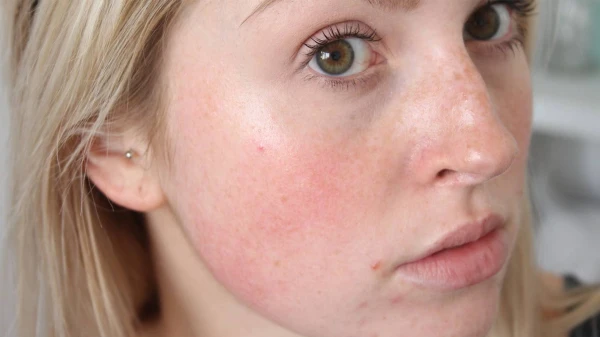 Изображение к статье: Что поможет избавиться от покраснений на лице: совет косметолога