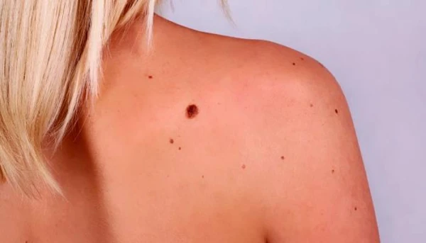 Изображение к статье: Первая больница приглашает на бесплатные обследования родинок