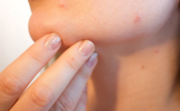 Изображение к статье: Карта лица: что могут означать прыщи