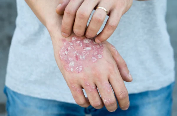 Изображение к статье: Медики ищут способов борьбы с напастью.