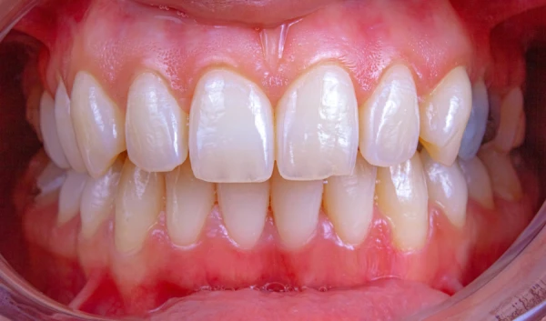 Изображение к статье: Раскрыта неожиданная связь между здоровьем десен и болезнями сердца