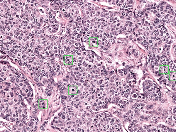 Раковая клетка сама ломает свою ДНК, и это можно использовать против нее.