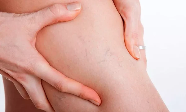 Когда на ногах видны вены: простые признаки, которые требуют внимания специалиста