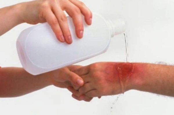 Изображение к статье: Как оказать помощь при ожоге в домашних условиях?