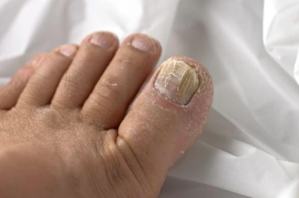 Можно ли избавиться от грибка кожи и ногтей с помощью хны?