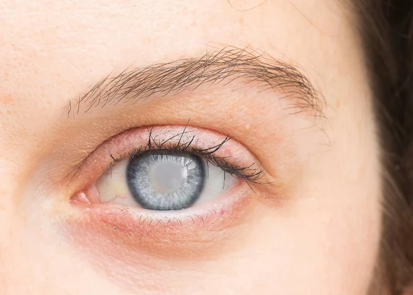 Изображение к статье: Ранние признаки глаукомы: как не пропустить опасное заболевание