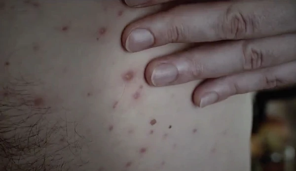 Изображение к статье: Вспышка опасной болезни в рижском Ильгюциемсе