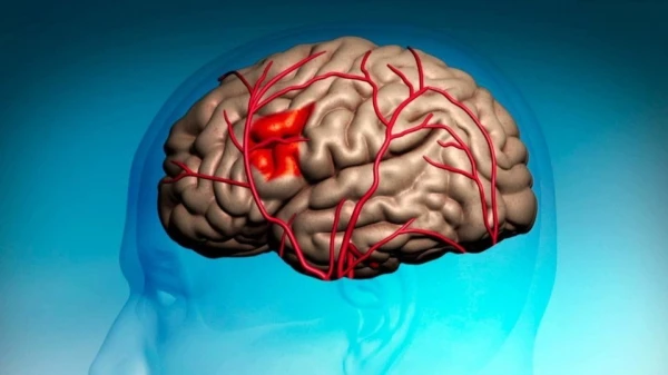 Революционная комбинация препаратов снижает риск повторного инсульта почти на 40%