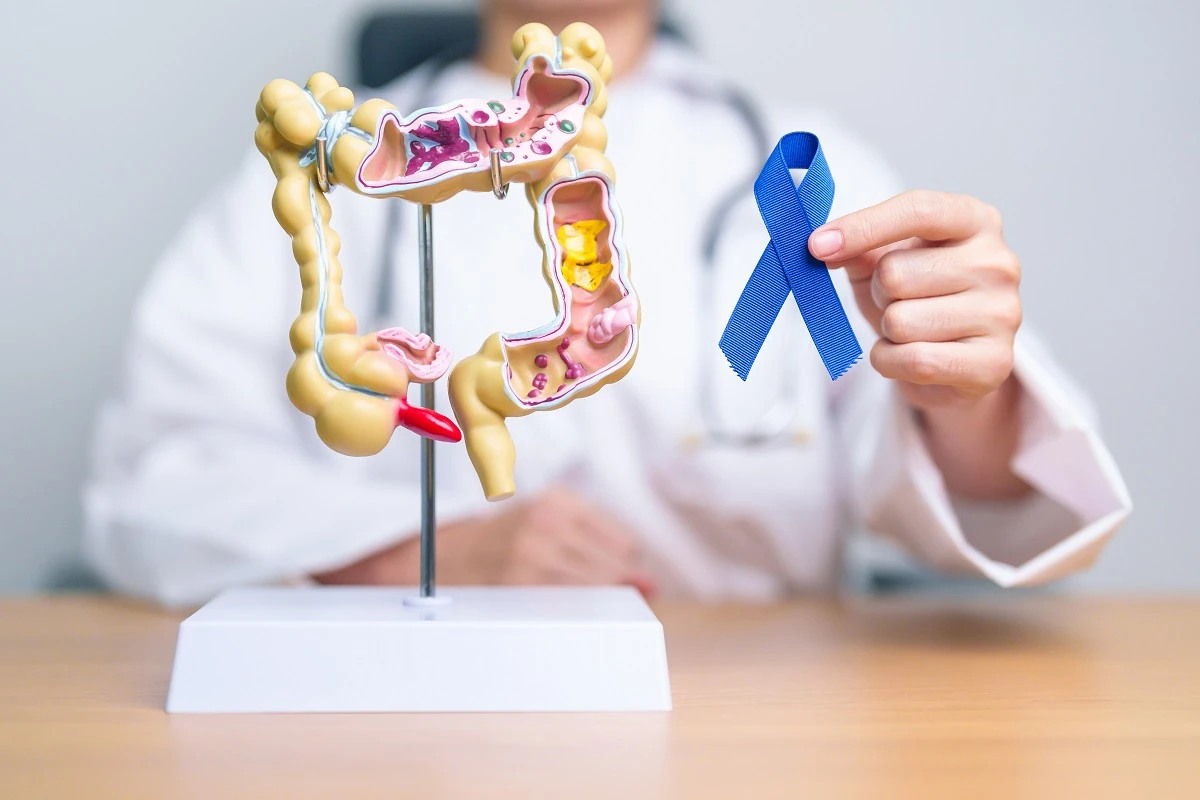 Изображение к статье: Ученые предупредили о росте рака кишечника у молодых людей
