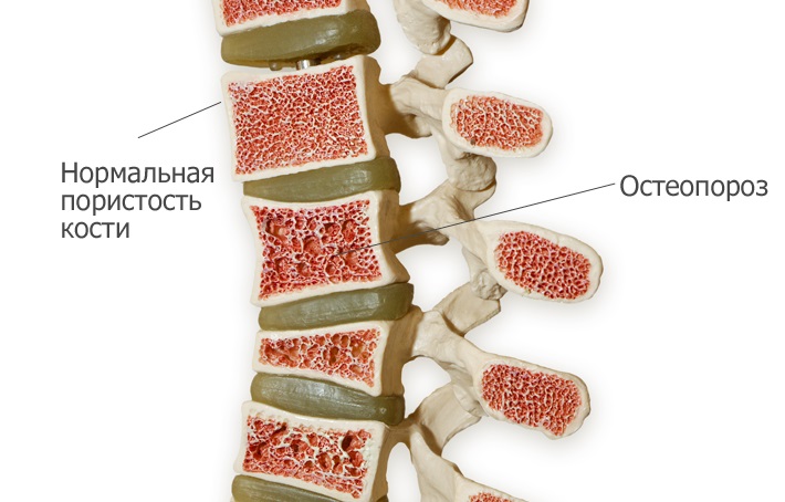 osteoporoz1.jpg