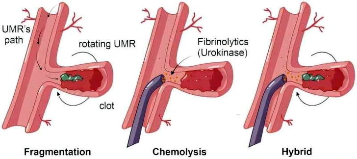 tromb_4.jpg